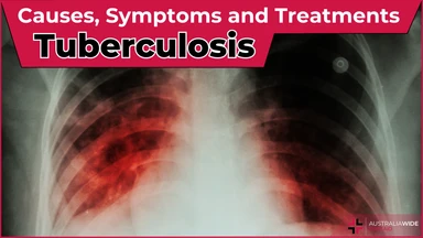 Tuberculosis article header – First Aid Article in Bendigo